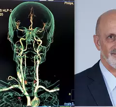 Ken Rosenfield, MD, Mass General Hospital, explains the impact wider CMS reimbursement for carotid artery stenting will have on patient stroke care and interventional cardiology. CAS