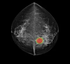 Example of a radiology diagnostic aid artificial intelligence (AI) algorithm with Lunit's mammography cancer lesion detection system.