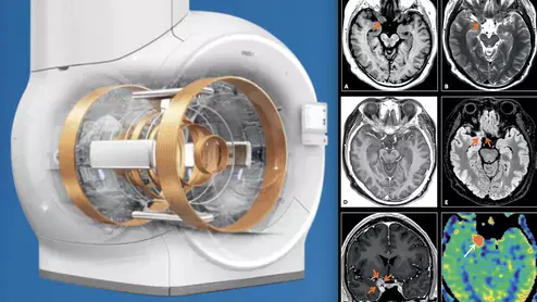 MRI system advances include helium-free MRI systems (left is Philips version of this system), and compressed sensing (right, GE's version of this technology), which can greatly reduce scan times. Both technologies were mentioned in an overview by Signet Research of new tech that will be at RSNA 2022. 